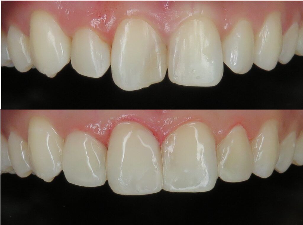 composite bonding smile makeover with dr biju krishnan