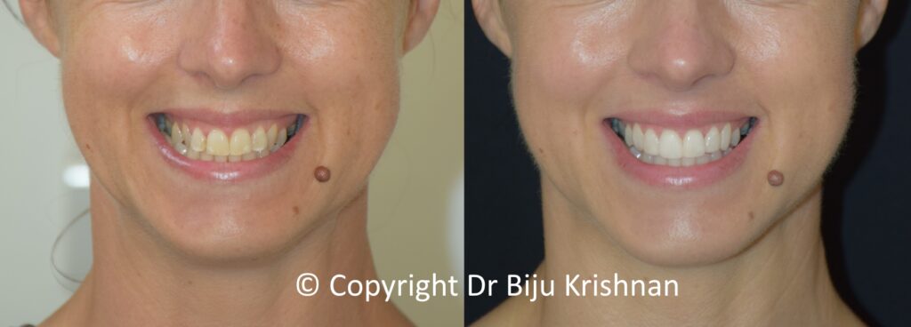 before & after smile makeover with dr biju krishnan cfast