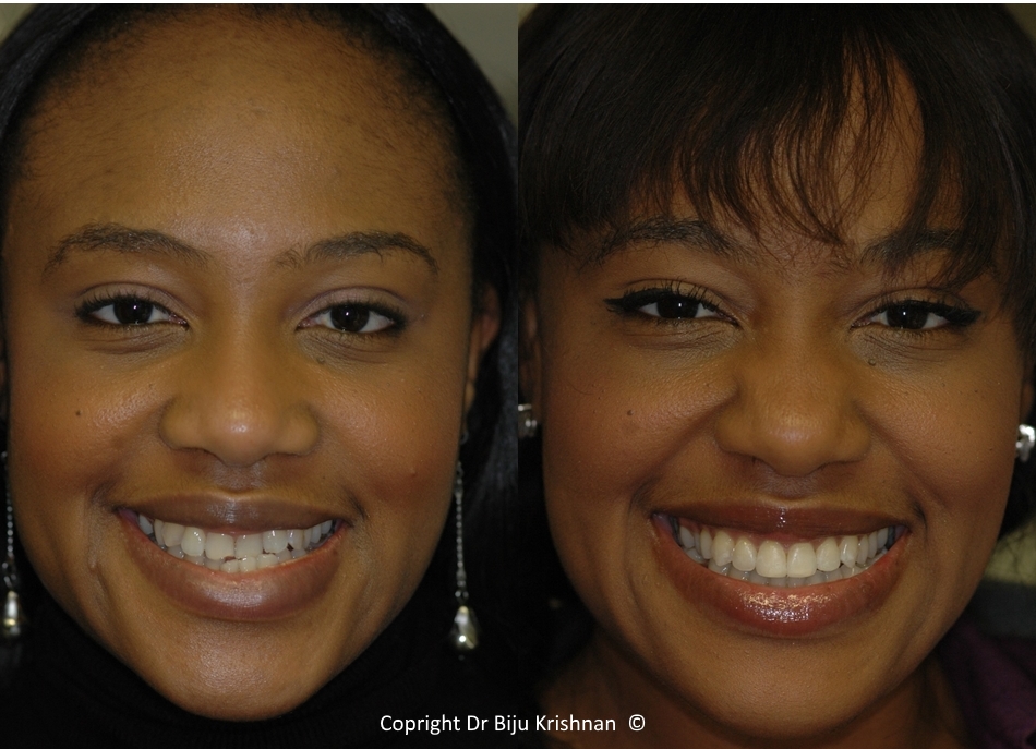 teeth straightening with dr biju krishnan